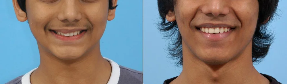 Smile before and after