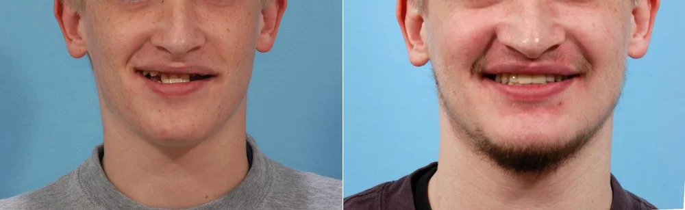 Smile before and after