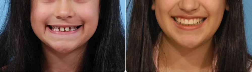 Smile before and after