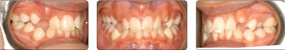 Teeth before Phase 2