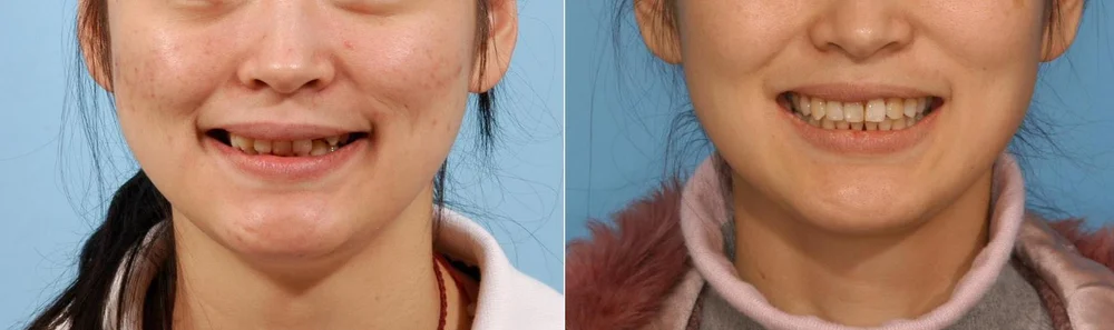 Smile before and after