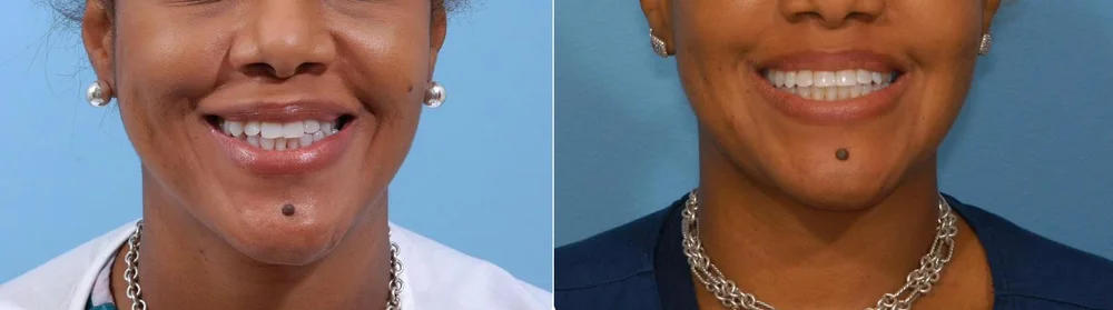 Smile before and after