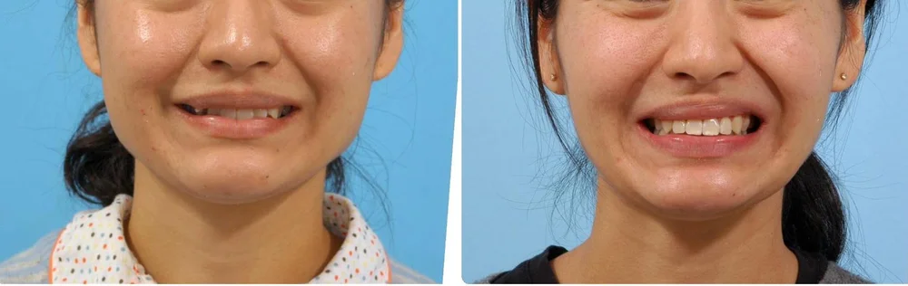 Smile before and after