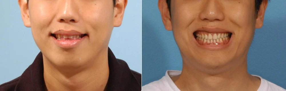 Smile before and after