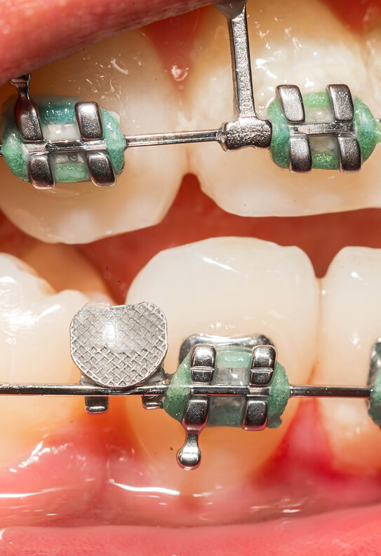 a close up of teeth with braces